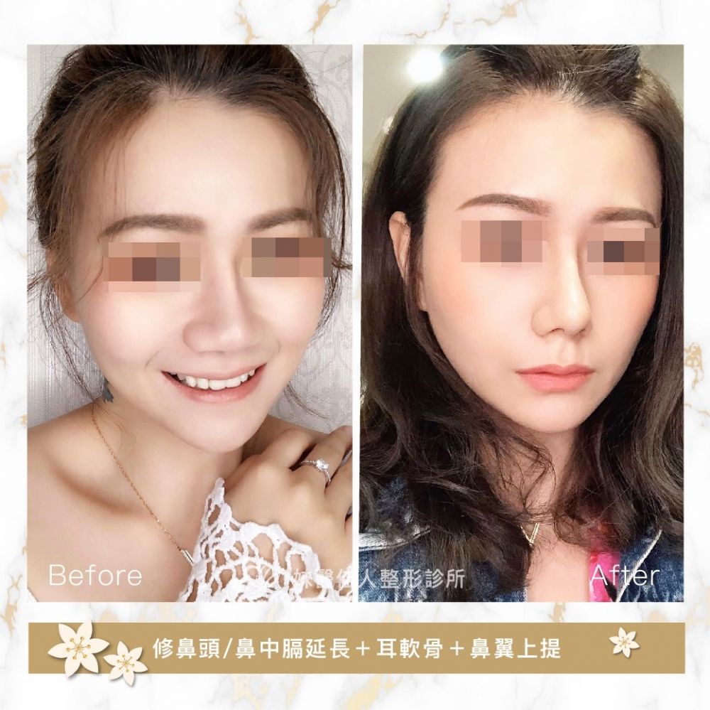 鼻部整形