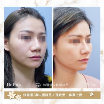 鼻部整形