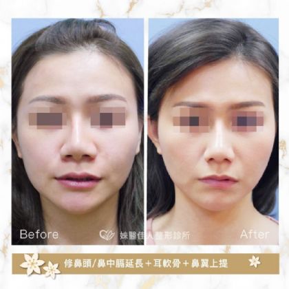 鼻部整形