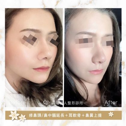 鼻部整形