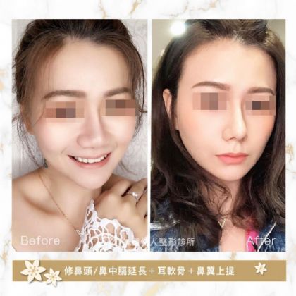 鼻部整形
