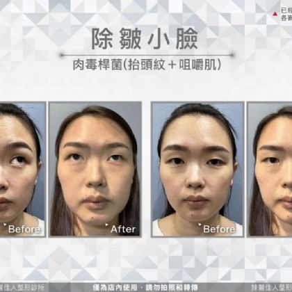咀嚼肌