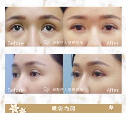 眼袋內開