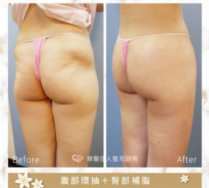 腹部環抽＋臀部補脂