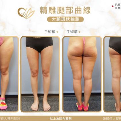 大腿抽脂
