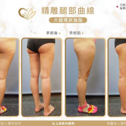 大腿抽脂