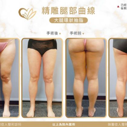 大腿抽脂