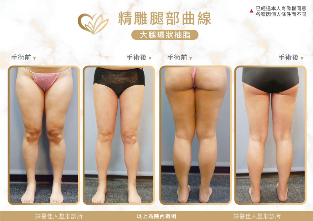 大腿抽脂